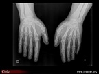 pseudohypoparathyroïdie: brachymétacarpie